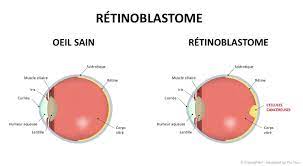 Traitement du rétinoblastome