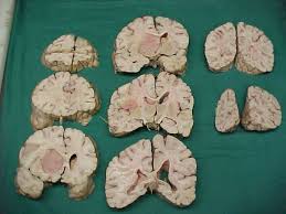 Tumeurs cérébrales anatomie pathologique