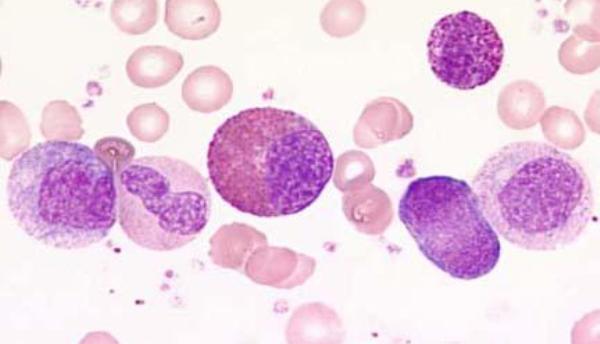 Les moyens de diagnostic en oncologie pédiatrique - L'anapath